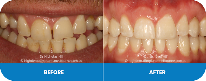 Clear aligners, fillings and AirFlow