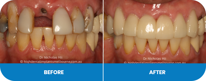 Crowns, porcelain veneers and an implant
